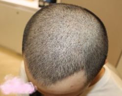 -大麦微针植发丨全国连锁