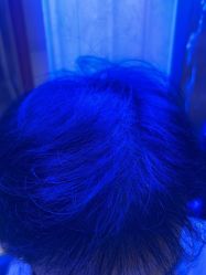 -碧莲盛·不剃发植发