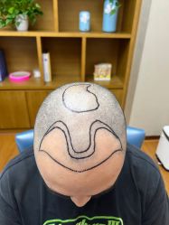 -大麦微针植发全国连锁