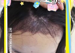 -大麦微针植发全国连锁