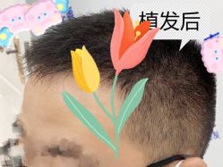 -大麦微针植发全国连锁