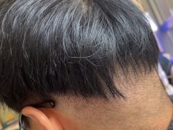 -碧莲盛·不剃发植发