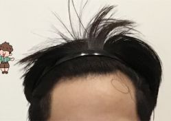 -大麦微针植发全国连锁