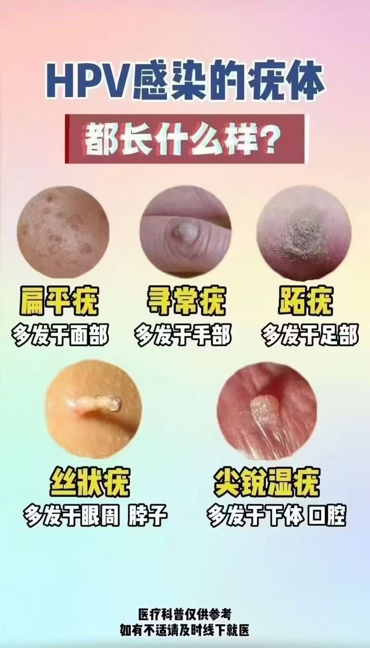 疣"传染吗
"一定会传染",尤其搓澡