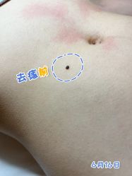 -清疣美疣·痣·斑净肤中心