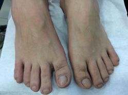 -德哥灰指甲脚气甲沟炎跖疣护理