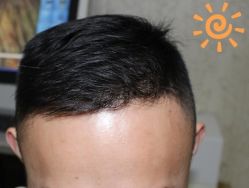 -大麦微针植发丨全国连锁