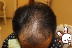 点击看大图 -大麦微针植发丨全国连锁