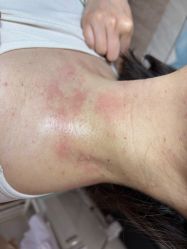 体验后-爱莎扁平疣·汗管瘤·斑痣中心