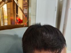 -碧莲盛·不剃发植发