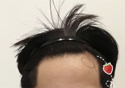 -大麦微针植发全国连锁