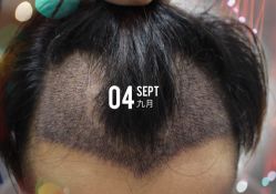 -大麦微针植发全国连锁