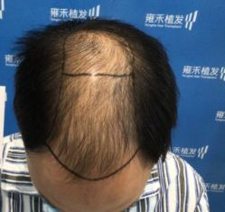 -雍禾植发全国连锁