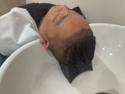 -大麦微针植发全国连锁