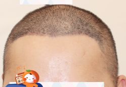 -大麦微针植发全国连锁