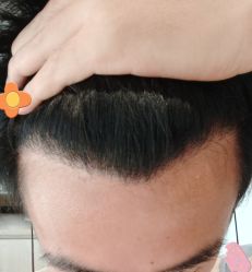 -大麦微针植发丨全国连锁