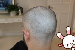 -大麦微针植发丨全国连锁