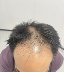 -大麦微针植发丨全国连锁