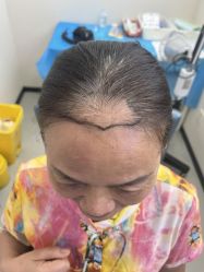 -大麦微针植发全国连锁