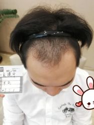 -大麦微针植发丨全国连锁