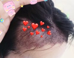 -大麦微针植发全国连锁