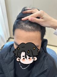 -大麦微针植发全国连锁