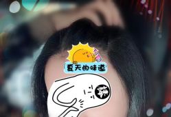 -大麦微针植发全国连锁