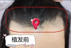 -大麦微针植发全国连锁