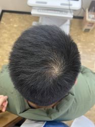 -大麦微针植发全国连锁