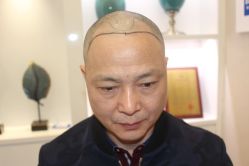 点击看大图 -大麦微针植发丨全国连锁
