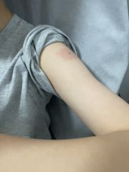 -北京美痣堂古方祛痣斑疣瘊