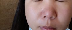 体验后-skin79皮肤管理中心