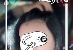 -大麦微针植发全国连锁