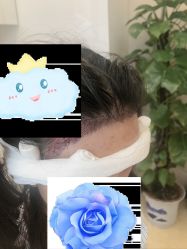 -大麦微针植发丨全国连锁