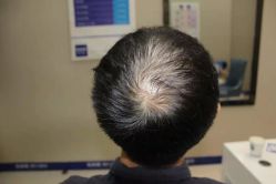 -大麦微针植发全国连锁