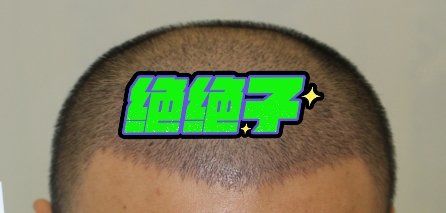 -大麦微针植发丨全国连锁