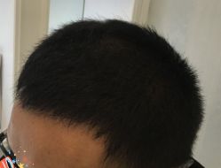 -大麦微针植发丨全国连锁