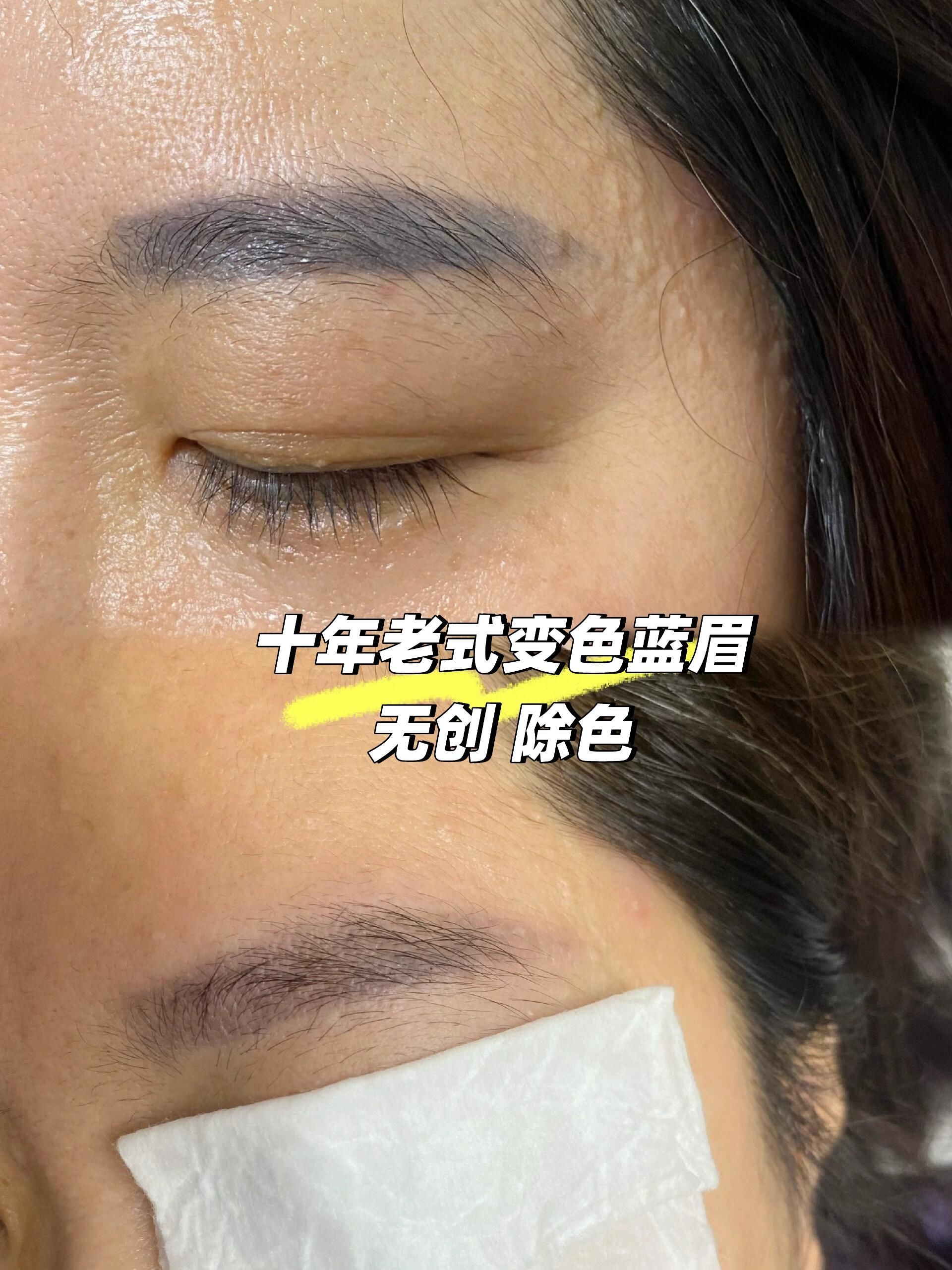 蓝眉一次淡化80%#武清洗眉
这位姐姐说自己的眉毛纹了大概十年了
