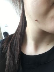 -爱莎扁平疣·汗管瘤·斑痣中心