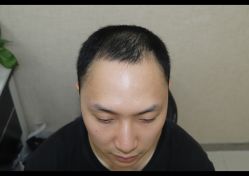 -大麦微针植发全国连锁