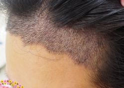 -大麦微针植发丨全国连锁