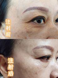 -More摩尔医美の注射线雕光电中心