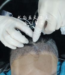 -碧莲盛·不剃发植发