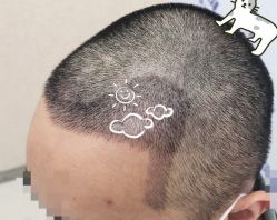 -大麦微针植发全国连锁