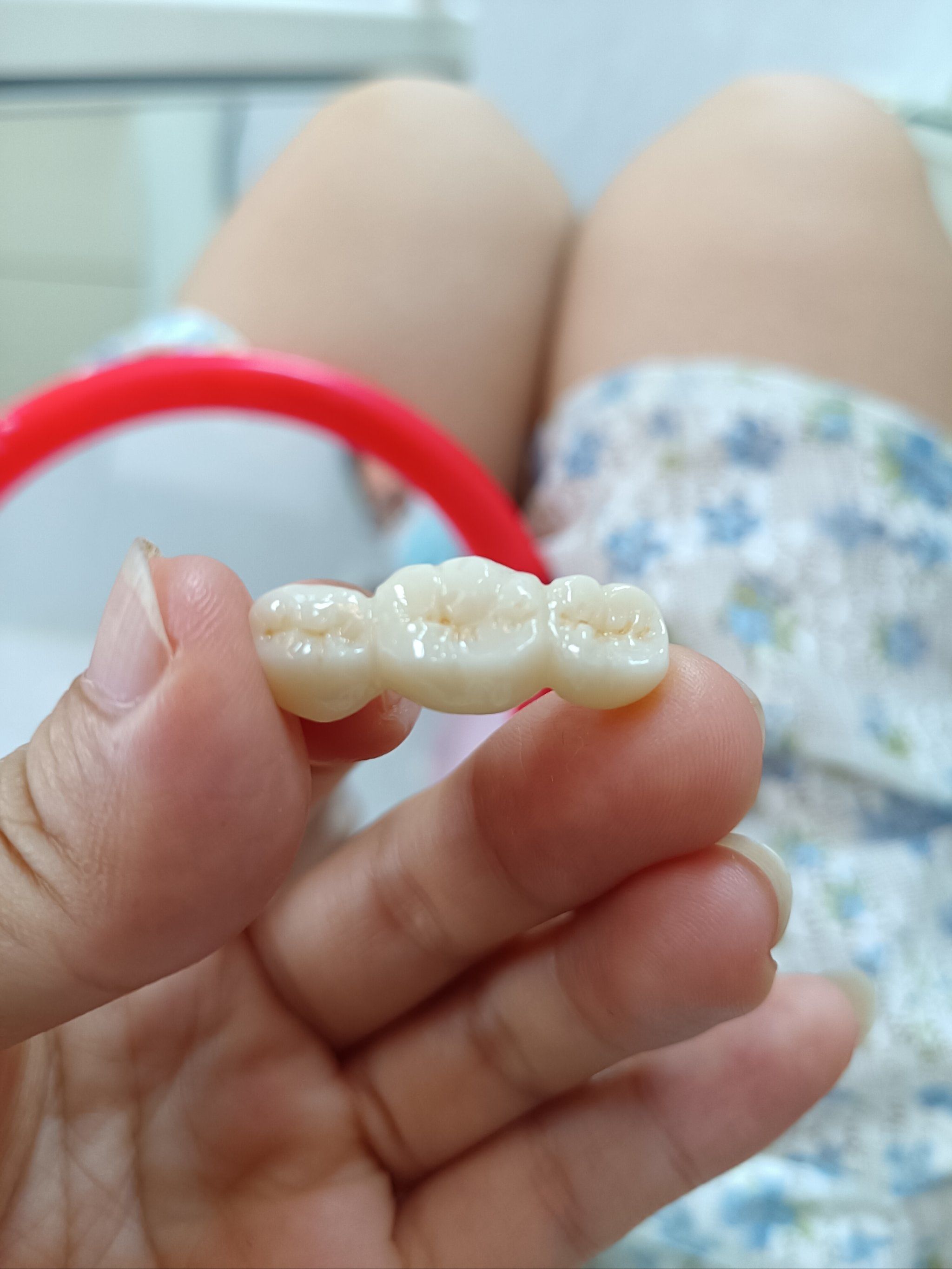 创作者赏金计划 #点评夏日有凉方 暑假期间回老家弄了牙齿,三连冠