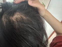 -碧莲盛·不剃发植发