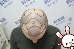 -大麦微针植发丨全国连锁