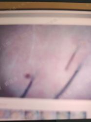 -碧莲盛·不剃发植发