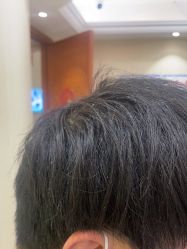 点击看大图 体验后-碧莲盛·不剃发植发