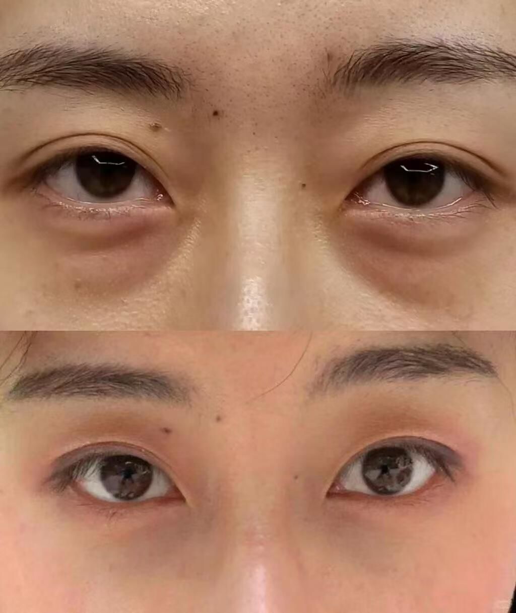 眼部皮肤是人体皮肤里最薄的
所以眼睛会比面部皮肤更快迈向衰老
